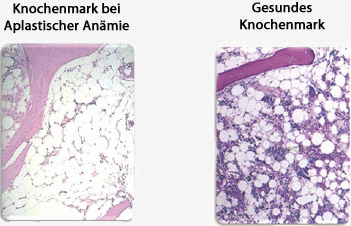 AA tanısı: Kemik iliği aplastik ve sağlıklı