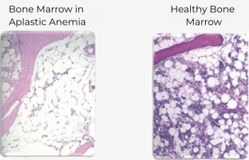 Diagnosis of AA: Healthy and aplastic bone marrow
